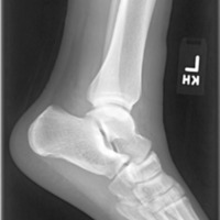 Ankle lateral