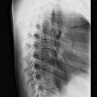 Thoracic spine oblique