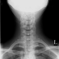 Cervical spine AP 2