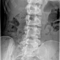 Lumbar spine oblique 1