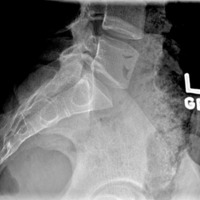 Lumbar Spine Lateral 2.png