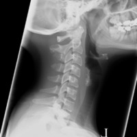 Cervical spine lateral