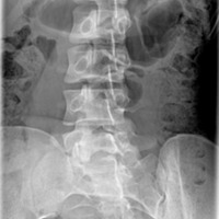 Lumbar spine oblique 2